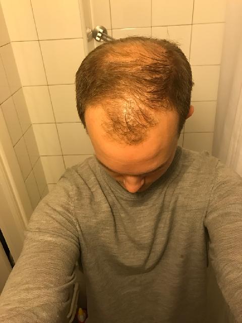 Hjässa före operation