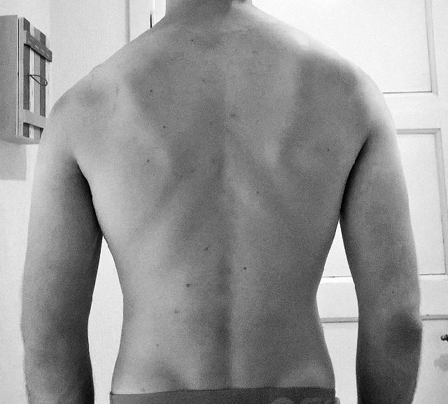 Rot scapula