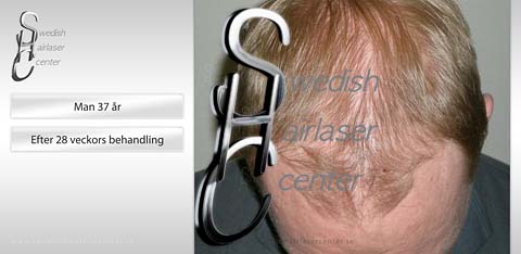 Shc 5 efter